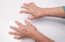 hands with rheumatoid arthritis hands with rheumatoid arthritis